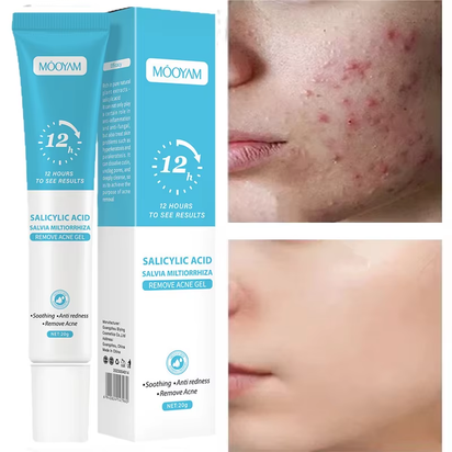 Acne Cream for Face Pimples Remover Treatment Shrink Pores Oil Control Lighten Acne Marks Whitening Smoothing Facial Skin Care