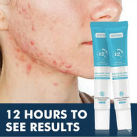 acne zero- cream and remover